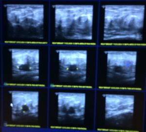 Sarah Cancer Mass